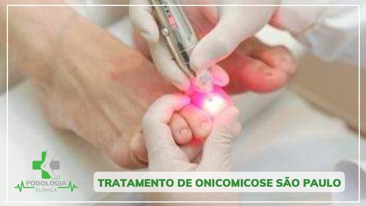Tratamento de Onicomicose São Paulo